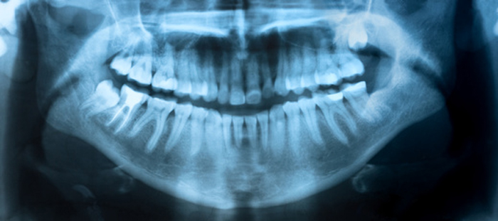 Dental X-Ray edmonton