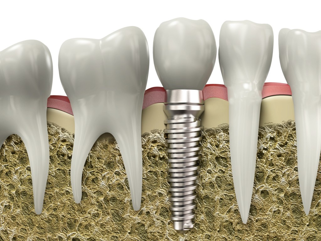 Dental implant edmonton