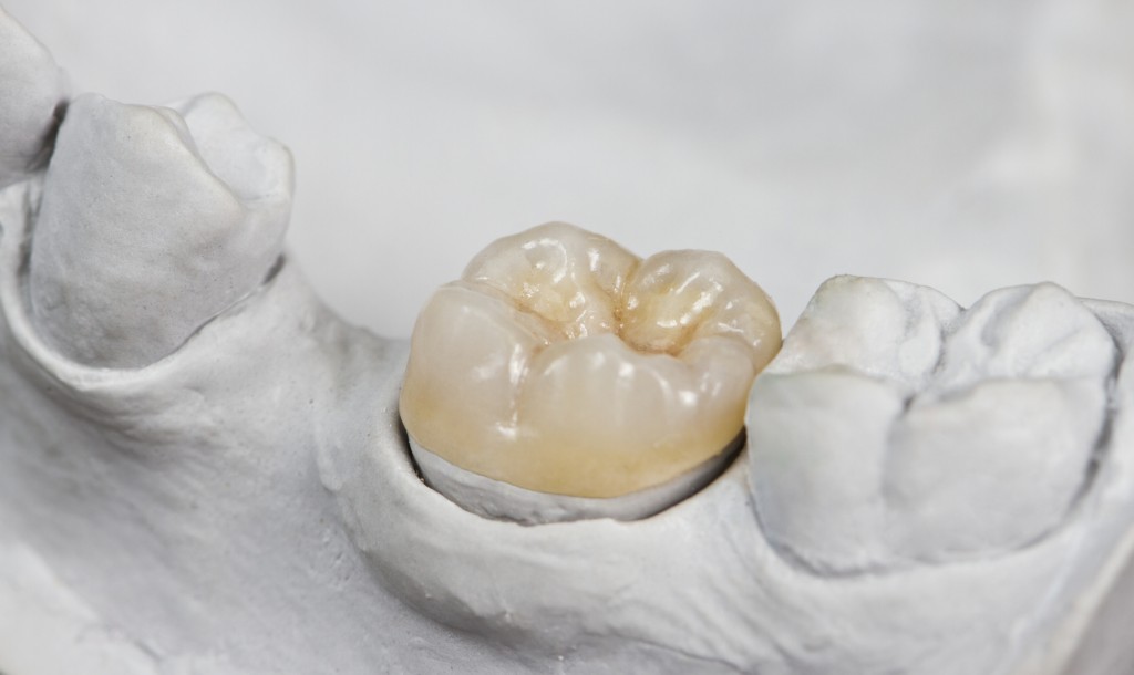 composite fillings