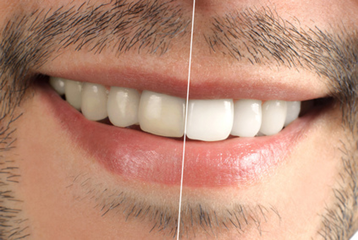 Teeth whitening edmonton