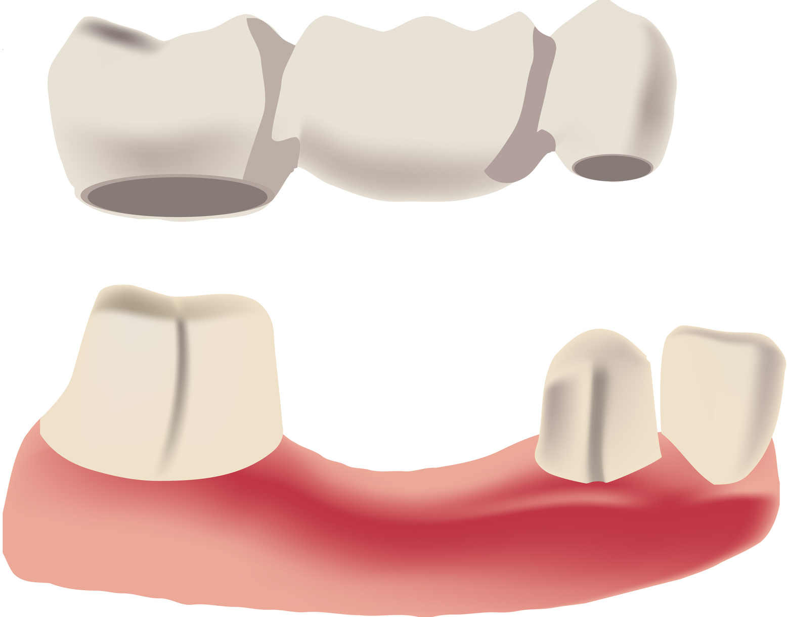 dental restoration